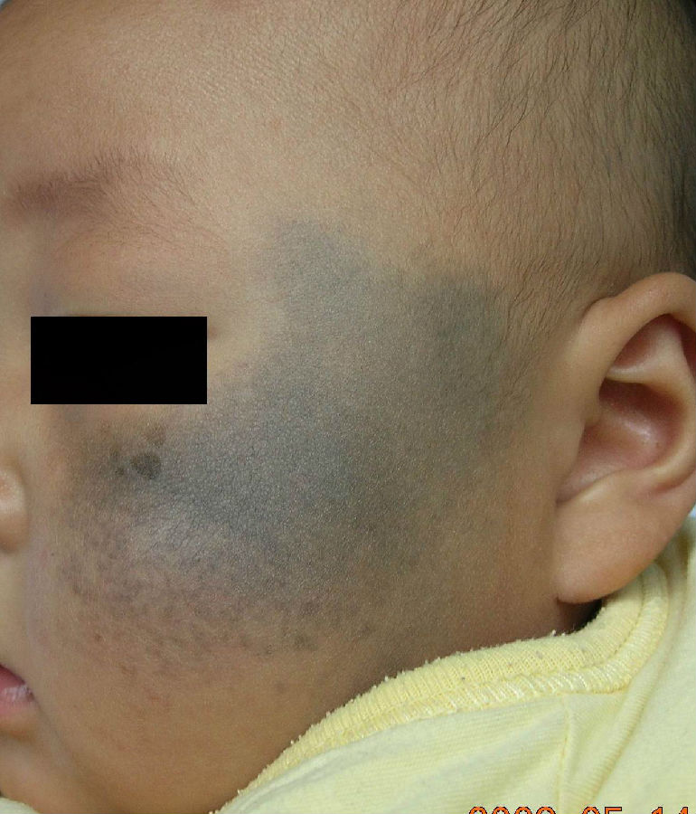 详细解读太田痣的发病原因