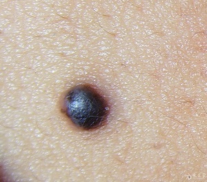 哪些色素痣容易发生癌变